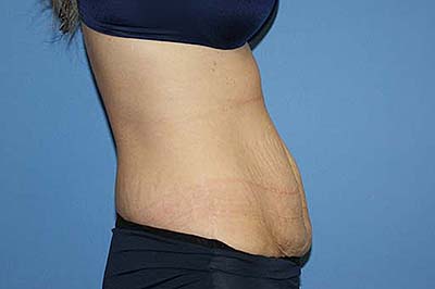 Tummy Tuck Before & After Patient #5664