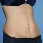 Tummy Tuck Before & After Patient #5664