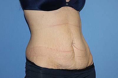 Tummy Tuck Before & After Patient #5664