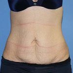 Tummy Tuck Before & After Patient #5664