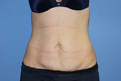 Tummy Tuck Before & After Patient #5664