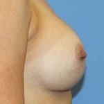 Breast Augmentation Before & After Patient #7091