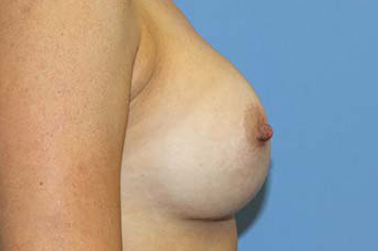 Breast Augmentation Before & After Patient #7091