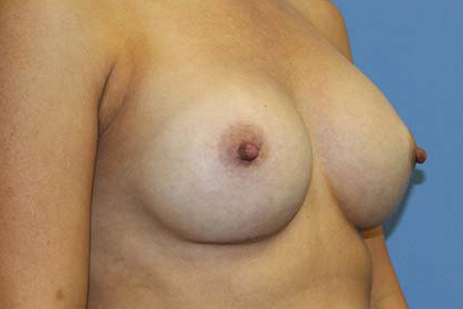 Breast Augmentation Before & After Patient #7091