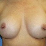 Breast Augmentation Before & After Patient #7091