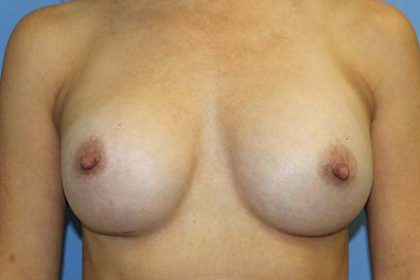 Breast Augmentation Before & After Patient #7091