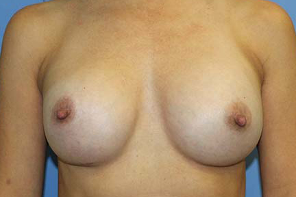 Breast Augmentation Before & After Patient #7091