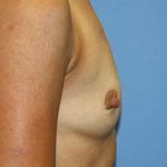 Breast Augmentation Before & After Patient #7091