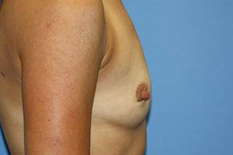 Breast Augmentation Before & After Patient #7091