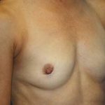 Breast Augmentation Before & After Patient #7091