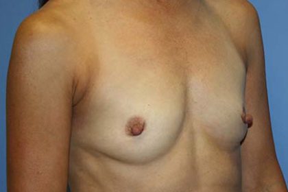 Breast Augmentation Before & After Patient #7091