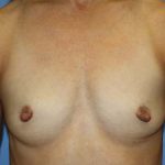 Breast Augmentation Before & After Patient #7091