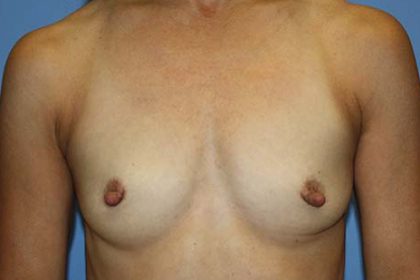 Breast Augmentation Before & After Patient #7091