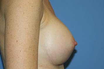 Breast Augmentation Before & After Patient #5672