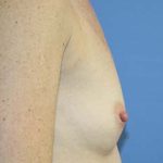 Breast Augmentation Before & After Patient #5672