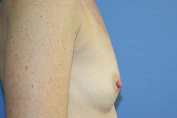 Breast Augmentation Before & After Patient #5672