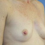 Breast Augmentation Before & After Patient #5672