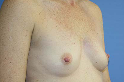 Breast Augmentation Before & After Patient #5672