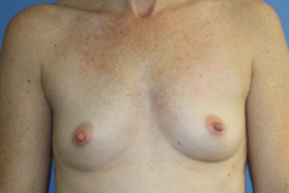 Breast Augmentation Before & After Patient #5672