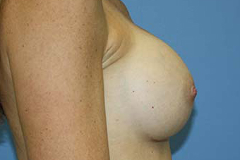 Breast Augmentation Before & After Patient #7092