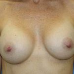 Breast Augmentation Before & After Patient #7092