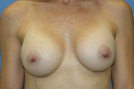 Breast Augmentation Before & After Patient #7092