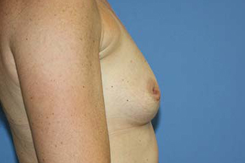 Breast Augmentation Before & After Patient #7092