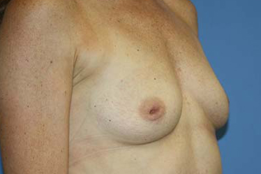 Breast Augmentation Before & After Patient #7092