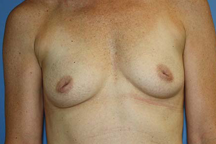 Breast Augmentation Before & After Patient #7092