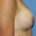 Breast Augmentation Before & After Patient #5696