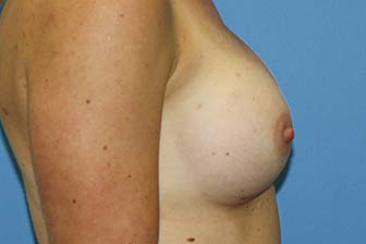 Breast Augmentation Before & After Patient #5696