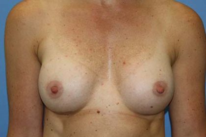 Breast Augmentation Before & After Patient #5696