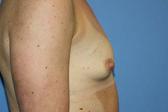 Breast Augmentation Before & After Patient #5696