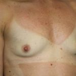 Breast Augmentation Before & After Patient #5696