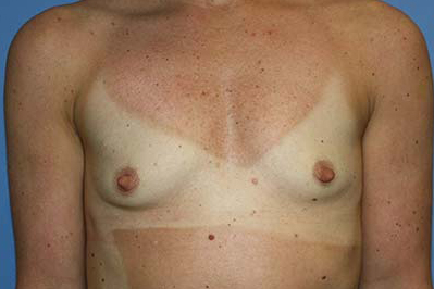 Breast Augmentation Before & After Patient #5696