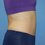 Tummy Tuck Before & After Patient #5697