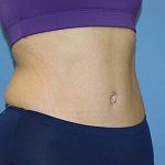 Tummy Tuck Before & After Patient #5697