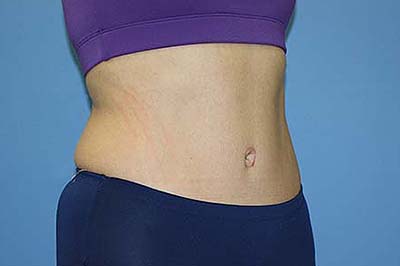 Tummy Tuck Before & After Patient #5697