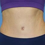 Tummy Tuck Before & After Patient #5697