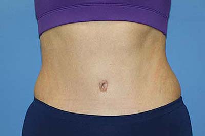 Tummy Tuck Before & After Patient #5697