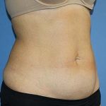 Tummy Tuck Before & After Patient #5697