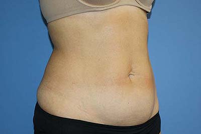 Tummy Tuck Before & After Patient #5697