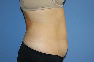 Tummy Tuck Before & After Patient #5697