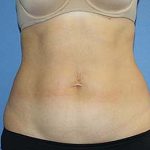 Tummy Tuck Before & After Patient #5697