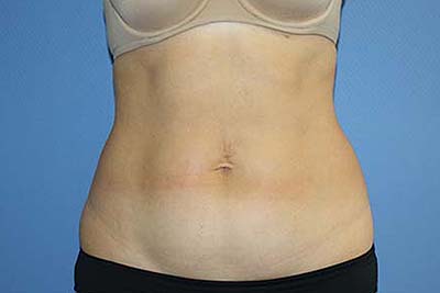 Tummy Tuck Before & After Patient #5697