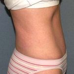 Tummy Tuck Before & After Patient #5704