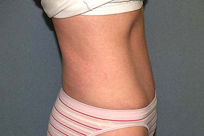 Tummy Tuck Before & After Patient #5704