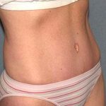 Tummy Tuck Before & After Patient #5704