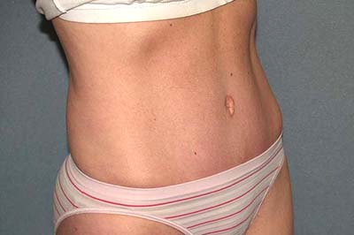 Tummy Tuck Before & After Patient #5704