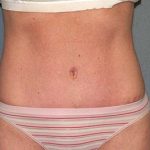 Tummy Tuck Before & After Patient #5704